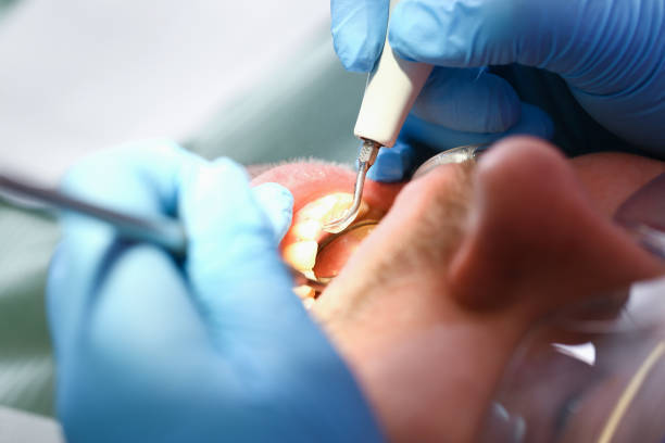 Best Emergency Root Canal Treatment in Seven Lakes, NC